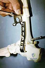 التحام مفصل الكاحل والكعب بالصفيحة النصلية: حل فعال لتشوهات القدم المعقدة مع الأستاذ الدكتور محمد هطيف