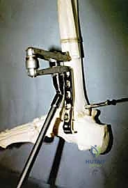 تدمير مفصل الكاحل بسبب السكري المتقدم