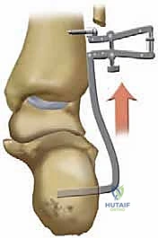 مقارنة بين العلاج التحفظي والجراحي بالأشعة