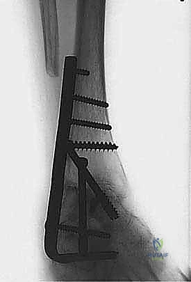 تثبيت مبدئي باستخدام أسلاك كيرشنر