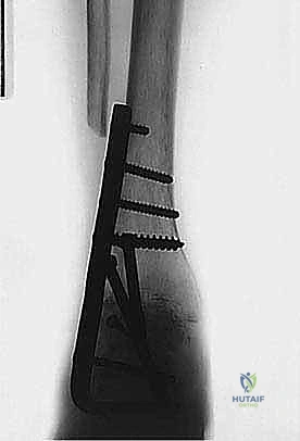 إبعاد الأنسجة الرخوة بحذر