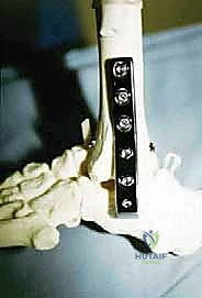 إزالة الغضاريف المتبقية لضمان الالتحام