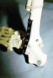 تسوية سطح عظمة قصبة الساق