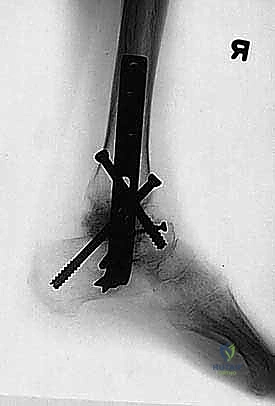 استئصال عظمة الكاحل التالفة