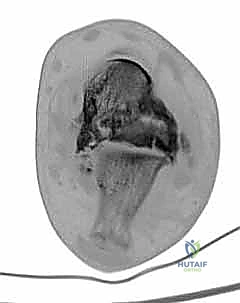 طرق النصل داخل العظم بحذر