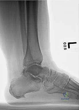 تثبيت الصفيحة بقوة على العظم