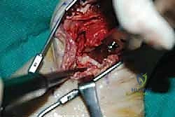 التأكد من إحكام البراغي في العظم