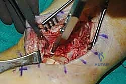 إدخال البراغي لتثبيت الصفيحة