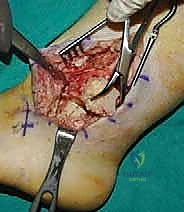 التثبيت النهائي للصفيحة النصلية