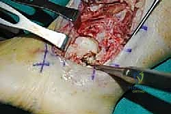 قياس طول البراغي المطلوبة بدقة