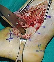 حفر أماكن البراغي في قصبة الساق