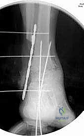 الخياطة التجميلية للجلد