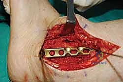 وضع الطعوم العظمية لتحفيز الالتحام