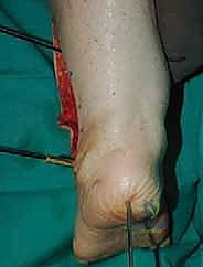 إغلاق الطبقات العميقة للأنسجة