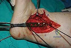 تنظيف الجرح قبل الإغلاق النهائي