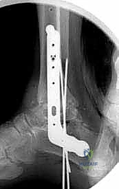 تغطية الجرح بالضمادات المعقمة