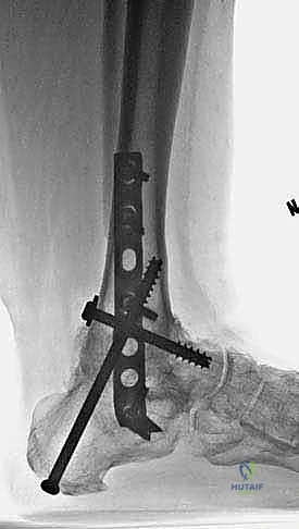 صورة توضيحية لـ التحام مفصل الكاحل والكعب بالصفيحة النصلية: حل فعال لتشوهات القدم المعقدة مع الأستاذ الدكتور محمد هطيف