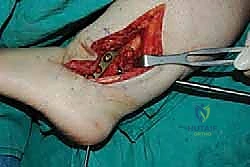 المريض في مرحلة التعافي الأولى