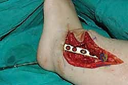 التئام الجرح بشكل ممتاز بعد أسابيع من الجراحة