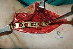 صورة شعاعية بعد العملية تظهر التثبيت الناجح