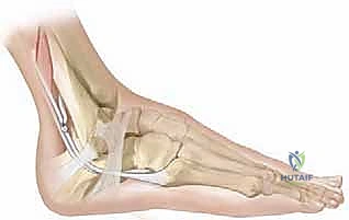 تثبيت الوتر في الموقع التشريحي الجديد