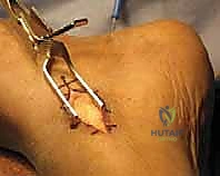 تقييم الأسباب العصبية والميكانيكية للقدم الحنفاء