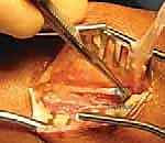 تمرير الوتر المقسم لتصحيح التوازن