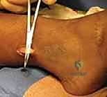 صورة توضيحية لـ جراحة نقل وتر الظنبوب الخلفي المقسم: حل فعال لتقوس القدم الحنفاء واستعادة التوازن