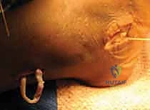 مقارنة الخيارات العلاجية للقدم الحنفاء