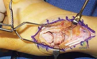شبكة الأربطة المعقدة التي تدعم مفصل الإبهام القاعدي