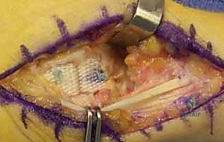 التشريح الدقيق لمفصل إبهام اليد والعظم المربعي