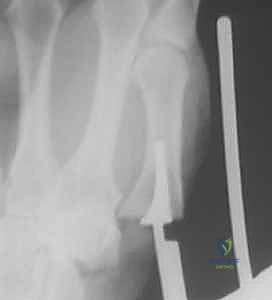 الفحص السريري والتشخيص الإشعاعي لمفصل الإبهام