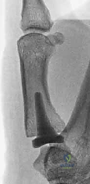 أسباب وعوامل خطر الإصابة بالتهاب مفصل الإبهام