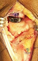 صورة توضيحية لـ جراحة مفصل إبهام اليد: حلول متقدمة لآلام الإبهام المزمنة مع الأستاذ الدكتور محمد هطيف