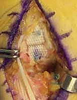 مراحل تآكل الغضروف وتضرر المفصل القاعدي للإبهام