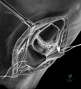 التحضير للتدخل الجراحي في مفصل الإبهام