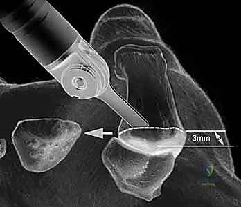 جراحة مفصل إبهام اليد: حلول متقدمة لآلام الإبهام المزمنة مع الأستاذ الدكتور محمد هطيف