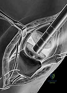 صورة توضيحية لـ جراحة مفصل إبهام اليد: حلول متقدمة لآلام الإبهام المزمنة مع الأستاذ الدكتور محمد هطيف