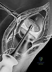جراحة استئصال العظم المربعي وإعادة بناء الأربطة LRTI