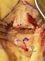 الخيارات العلاجية التحفظية لالتهاب مفصل الإبهام