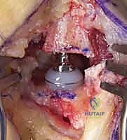 صورة توضيحية لـ جراحة مفصل إبهام اليد: حلول متقدمة لآلام الإبهام المزمنة مع الأستاذ الدكتور محمد هطيف