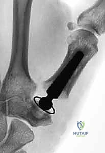 Illustration of thumb carpometacarpal joint - Dr. Mohammed Hutaif