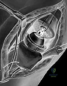 صورة توضيحية لـ جراحة مفصل إبهام اليد: حلول متقدمة لآلام الإبهام المزمنة مع الأستاذ الدكتور محمد هطيف