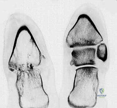 Illustration of infection of the talus - Dr. Mohammed Hutaif