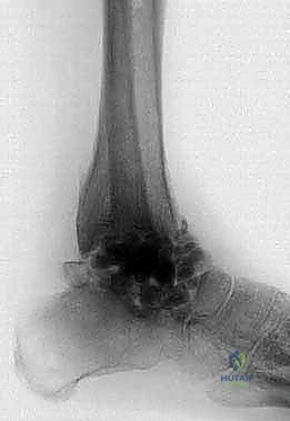 أسباب النخر اللاوعائي وفقدان عظم الكاحل