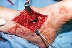 صورة توضيحية لـ تثبيت مفصل الكاحل والقدم (Tibial-Calcaneal Arthrodesis)