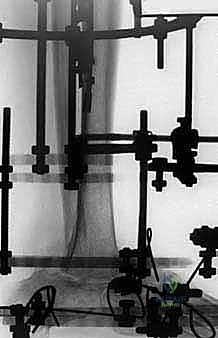 تثبيت مفصل الكاحل والقدم (Tibial-Calcaneal Arthrodesis): حل جذري لفقدان عظم الكاحل والعدوى