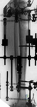 تشخيص حالات تلف مفصل الكاحل والقدم