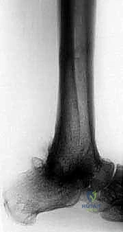 صورة توضيحية لـ تثبيت مفصل الكاحل والقدم (Tibial-Calcaneal Arthrodesis): حل جذري لفقدان عظم الكاحل والعدوى
