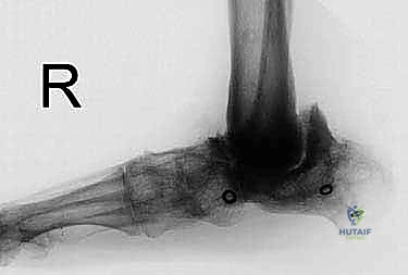 صورة توضيحية لـ تثبيت مفصل الكاحل والقدم (Tibial-Calcaneal Arthrodesis): حل جذري لفقدان عظم الكاحل والعدوى